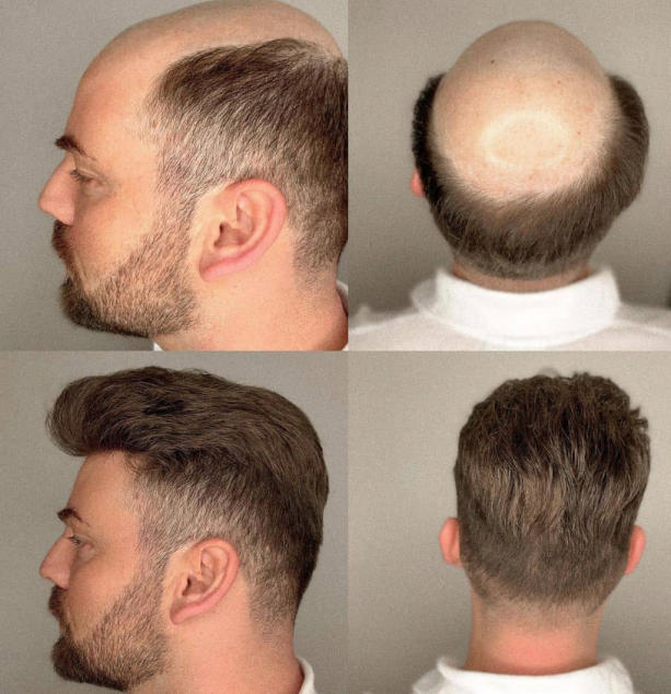 Toupeeunion 0.08mm Ultra Thin Skin Toupee Remy Human Hair Replacement System V-Looped Front Hair Piece For Men Natural Hairline Mens Hairpiece