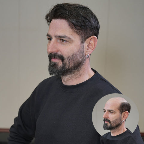 non surgical hair replacement ToupeeUnion